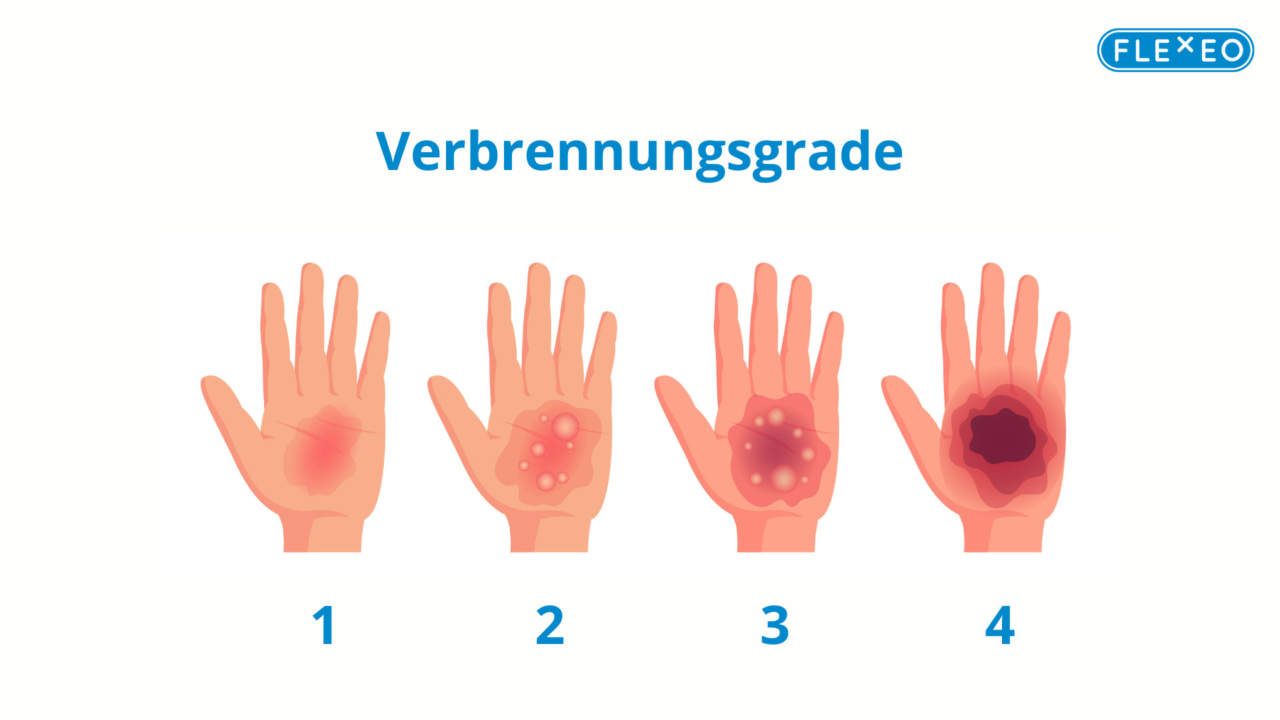 Verbrennungen Behandeln Flexeo