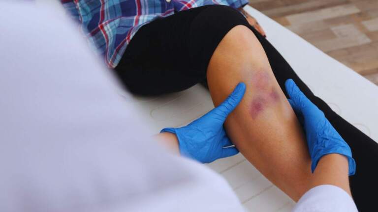 Prellungen behandeln - Was hilft gegen eine Prellung? | FLEXEO